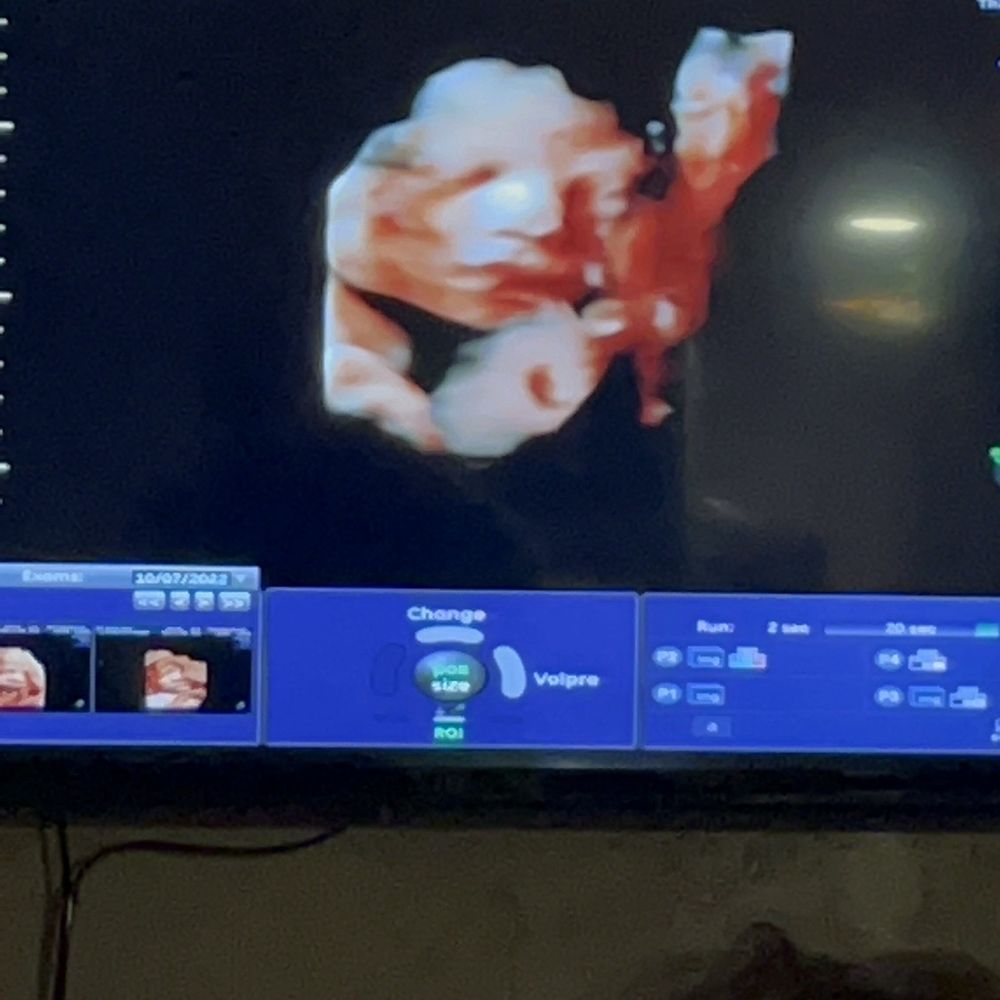 Miracle View 3D/4D Ultrasound - Obstetricians & Gynecologists Near Me - Phoenix, Arizona Miracle View 3D/4D Ultrasound - Obstetricians & Gynecologists Near Me - Phoenix, Arizona