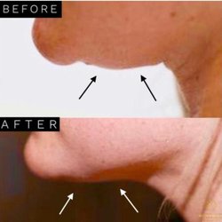 Buffalo Aesthetics - Kybella for Fat Burning
