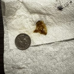 FT Worth ENT - This is what they did to me. Irregular mucus buildup since my surgery but they won't answer any calls.
