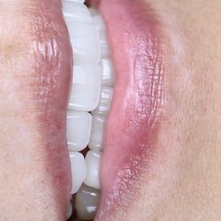 West Park Dental - 12 porcelain veneers upper and lower smile make over
