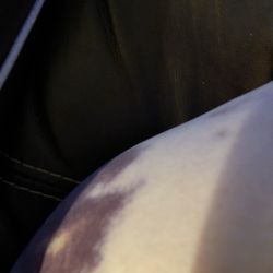 Bruises sustained