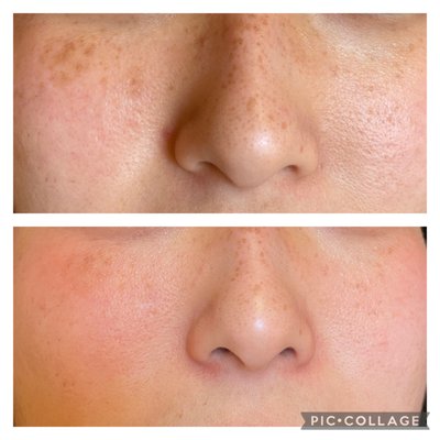 Signature PRP Facial - On SALE for $245 Per Treatment! - What is microneedling?
Microneedling is a minimally invasive cosmetic procedure that’s used to treat skin concerns via collagen production. Also known as collagen induction therapy, this treatment may help those looking to reduce the appearance of acne scars and stretch marks.
It’s also used in certain anti-aging procedures, such as eyelid surgery and sun spots.
You may be an ideal candidate for this procedure if you’re in good health and have certain skin concerns that haven’t responded to home treatments or other types of dermatologic procedures, such as peels.
This may also be a final step before considering cosmetic surgery for anti-aging and other concerns. Learn more about microneedling and talk to your dermatologist to see if this is the right option for your skin. Signature PRP Facial - On SALE for $245 Per Treatment! - What is microneedling?
Microneedling is a minimally invasive cosmetic procedure that’s used to treat skin concerns via collagen production. Also known as collagen induction therapy, this treatment may help those looking to reduce the appearance of acne scars and stretch marks.
It’s also used in certain anti-aging procedures, such as eyelid surgery and sun spots.
You may be an ideal candidate for this procedure if you’re in good health and have certain skin concerns that haven’t responded to home treatments or other types of dermatologic procedures, such as peels.
This may also be a final step before considering cosmetic surgery for anti-aging and other concerns. Learn more about microneedling and talk to your dermatologist to see if this is the right option for your skin.