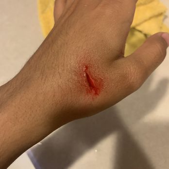 Banner Urgent Care - When I cut myself, instead of the fruit - Urgent Care Near Me - Goodyear, Arizona Banner Urgent Care - When I cut myself, instead of the fruit - Urgent Care Near Me - Goodyear, Arizona