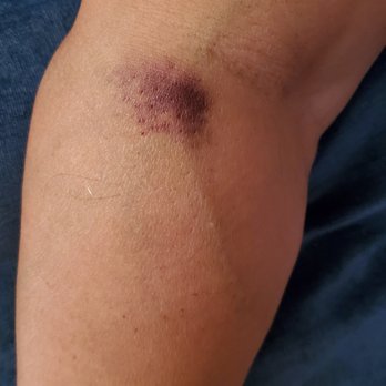 Quest Diagnostics - Inside right elbow. - Laboratory Testing Near Me - El Cajon, California