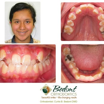 Bedont Orthodontics - 1) BEFORE - Orthodontists Near Me - Camas, Washington