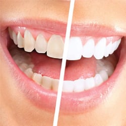 1Smile Dental Clinic - Teeth Whitening at http://www.1smile.co.uk