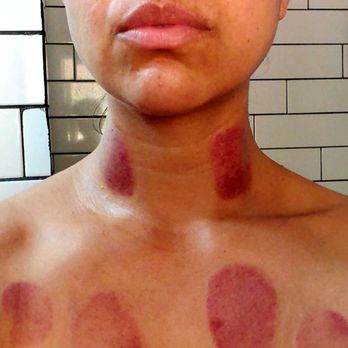 Solis - Chest opener. Cupping stagnation marks. No they don't hurt. - Acupuncture Near Me - Capitola, California