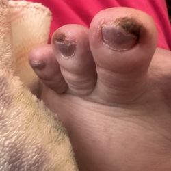 Michael A Doughty, DPM - Doughty Podiatry - Bloody toes next day after he told me to remove bandages just for clipping's