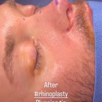 Aaron Kosins, MD - After - Cosmetic Surgeons Near Me - Newport Beach, California