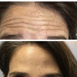 Fresh Medical Aesthetics - Before/after Botox in forehead