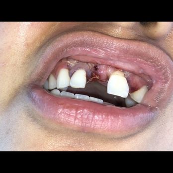 May Dental - Right after surgery 2 bone graphs/ reconstruction of my gum tissue - Cosmetic Dentists Near Me - Valencia, California May Dental - Right after surgery 2 bone graphs/ reconstruction of my gum tissue - Cosmetic Dentists Near Me - Valencia, California