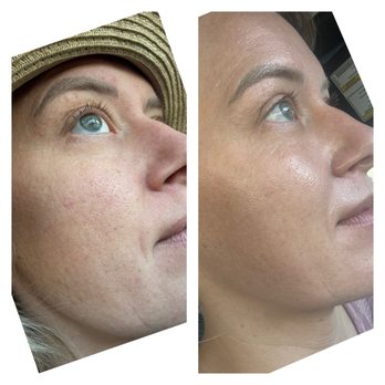 TROIAREUKE California - Before and after of my skin. I got the recommended hydration facial. - Skin Care Near Me - Buena Park, California