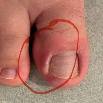Sophie’s Nail Studio - Infection on toe right before photo taken large pocket of pus popped out from area - Nail Salons Near Me - Jersey City, New Jersey Sophie’s Nail Studio - Infection on toe right before photo taken large pocket of pus popped out from area - Nail Salons Near Me - Jersey City, New Jersey