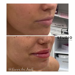 Studio Medical Aesthetics - Lip filler.