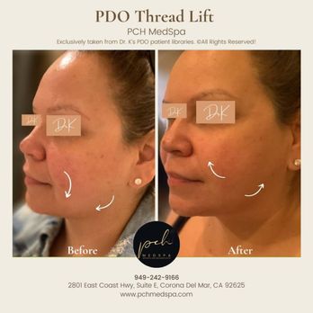 PCH MedSpa - PDO Thread Lift - Medical Spas Near Me - Corona Del Mar, California PCH MedSpa - PDO Thread Lift - Medical Spas Near Me - Corona Del Mar, California