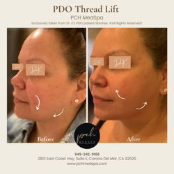 PCH MedSpa - PDO Thread Lift