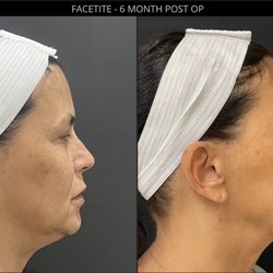 SkinMD - FACETITE - 6 months POST OP