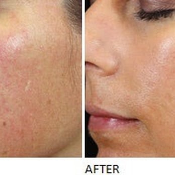 About Face Skin Therapy - A chemical peel helps scarring and is anti-aging - Day Spas Near Me - Seabrook, Texas