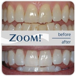 Moeiz Koshki, DDS - You, too, can have whiter teeth in just one hour!