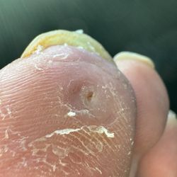 Proliance Orthopaedics & Sports Medicine - The hole from the dead skin created by the screw
