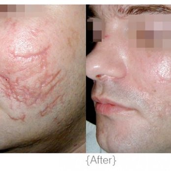 Skin Guardian - DMK Scar revision. One year after. Regular monthly treatments plus full home care. Results may vary. #dmkrrpm - Medical Spas Near Me - Beverly Hills, California Skin Guardian - DMK Scar revision. One year after. Regular monthly treatments plus full home care. Results may vary. #dmkrrpm - Medical Spas Near Me - Beverly Hills, California