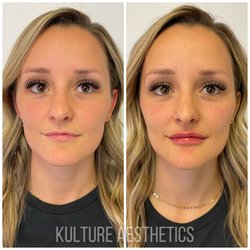 Mini full face refresh with dermal fillers
