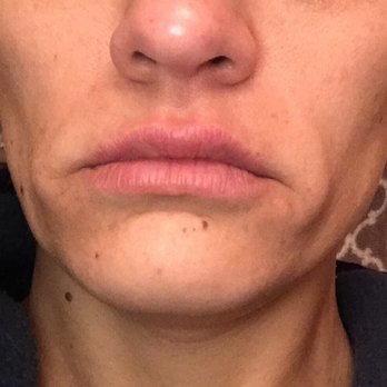 San Diego Body Contouring - After filler - Cosmetic Surgeons Near Me - San Diego, California San Diego Body Contouring - After filler - Cosmetic Surgeons Near Me - San Diego, California