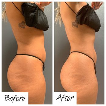 Bare Body Sculpting - Before & After: One hour session of ultrasonic cavitation, radio frequency skin tightening and wood therapy - Body Contouring Near Me - Santa Barbara, California Bare Body Sculpting - Before & After: One hour session of ultrasonic cavitation, radio frequency skin tightening and wood therapy - Body Contouring Near Me - Santa Barbara, California
