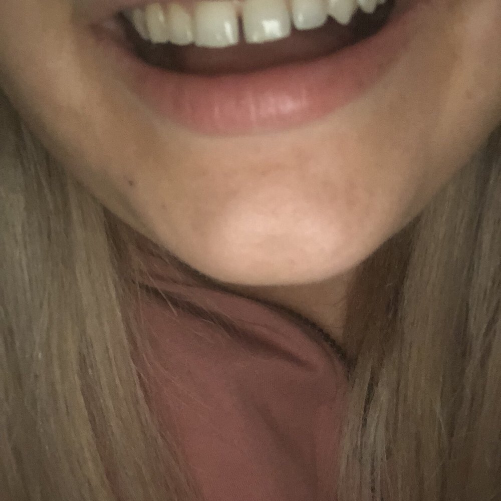 Studio City Dental Arts - Before smile. - Cosmetic Dentists Near Me - Studio City, California Studio City Dental Arts - Before smile. - Cosmetic Dentists Near Me - Studio City, California