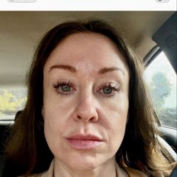 Petroff Center Plastic Surgery and Medi-Spa - This is after, on Sept 30.