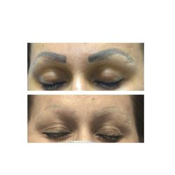 Before and after picture of tattoo removal on the eyebrows!
( Microblading). We used our PicoSure laser to remove cosmetic ink.