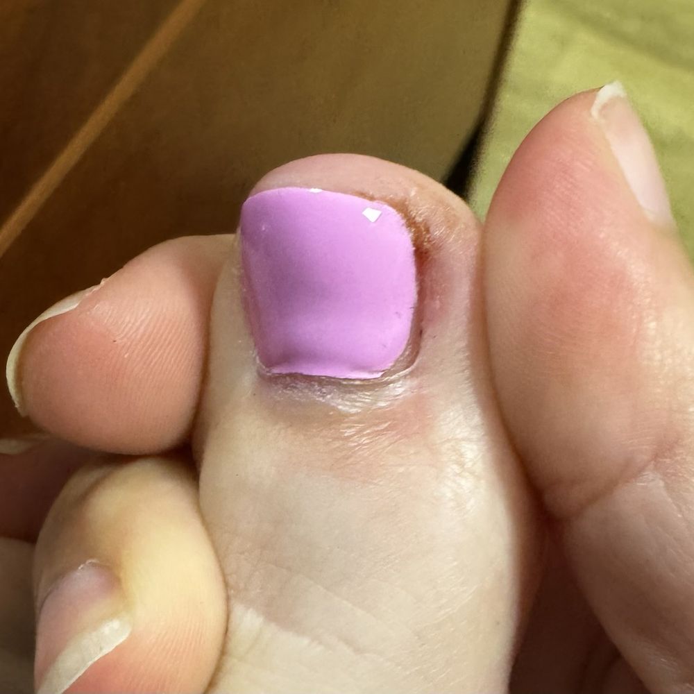 Possibly infected toe from unprofessional nail tech who put nail glue on my toe after cutting it causing it to bleed. Possibly infected toe from unprofessional nail tech who put nail glue on my toe after cutting it causing it to bleed.