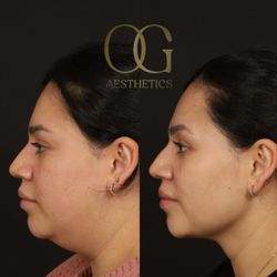 OG Aesthetics - 32 yo F 3 months after submental liposuction and RF Microneedling