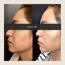 RenewMD - Dark Spots, Hyperpigementation fading using Picosure Pro laser. RenewMD is nationally recognized for laser resurfacing for darker skin tone