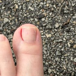 D&V Nails - My bleeding toe where the young "tech" pulled my skin and said "it's ok".