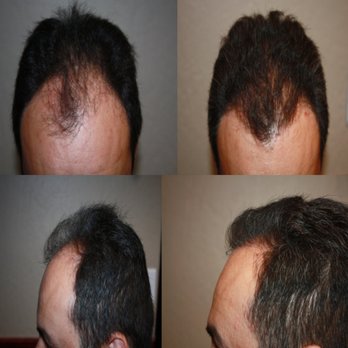 Tom Rosanelli, M.D. - Surgical restoration - Hair Loss Centers Near Me - Walnut Creek, California Tom Rosanelli, M.D. - Surgical restoration - Hair Loss Centers Near Me - Walnut Creek, California