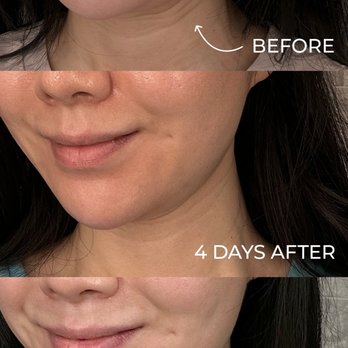 Roena Medspa - Platysmal botox - Medical Spas Near Me - Cerritos, California Roena Medspa - Platysmal botox - Medical Spas Near Me - Cerritos, California