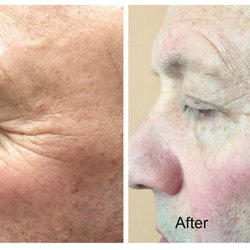 Iris Beauty Solution - After One RF Skin Tightening Treatment Victor's face looks 10 years younger.