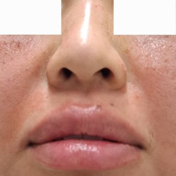 Total Body Aesthetic - Love my lips. Anna does amazing work! - Skin Care Near Me - Los Angeles, California