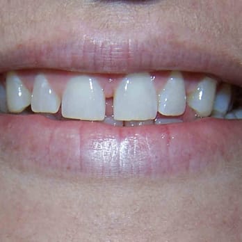Michael G Thomas, DDS - gap before - Cosmetic Dentists Near Me - Arlington, Texas Michael G Thomas, DDS - gap before - Cosmetic Dentists Near Me - Arlington, Texas