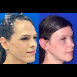 Artur Fahradyan, MD - MD Art Plastic Surgery - Facial Feminization