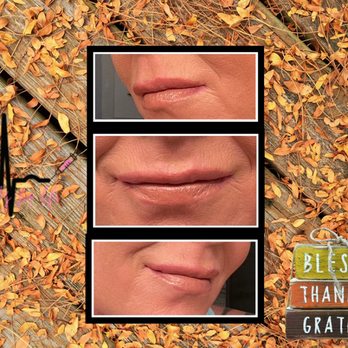 Beauty For Life - Lip filler - Aestheticians Near Me Beauty For Life - Lip filler - Aestheticians Near Me