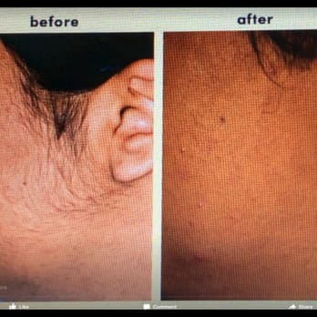 Sabaya Forever Salon - Before & After sideburns - Laser Hair Removal Near Me - Dearborn, Michigan Sabaya Forever Salon - Before & After sideburns - Laser Hair Removal Near Me - Dearborn, Michigan