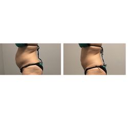 Foskaris Wellness - Results-6 sessions in 14 days