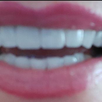 Ryan Savage, DDS - After - Cosmetic Dentists Near Me - Orange, California Ryan Savage, DDS - After - Cosmetic Dentists Near Me - Orange, California