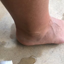 Swollen foot from orthotic and I'll fitted shoe from good feet store. Swollen foot from orthotic and I'll fitted shoe from good feet store.