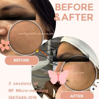Beyond Charms & Curves - Microneedling - Skin Care Near Me - Bakersfield, California Beyond Charms & Curves - Microneedling - Skin Care Near Me - Bakersfield, California