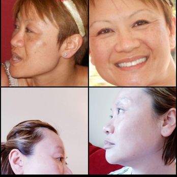 Flutter and Wink - Top Before (circa 2014)  Hyperpigmentation  Below After: (circa 2018)Beautiful results with microneedling, good skin regimen,time, patience. - Eyelash Service Near Me - Vancouver, Washington