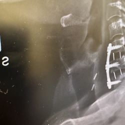 Hogan Smith Law - I have placed a platinum device on my neck spinal cord that prevents me lifting too much weight. Resulted in a disability.