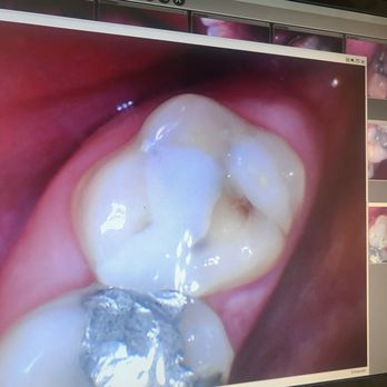 Creekside Dental - my BLOODY tooth that is needing a root canal now due to this office ineptitude - General Dentistry Near Me - Temecula, California